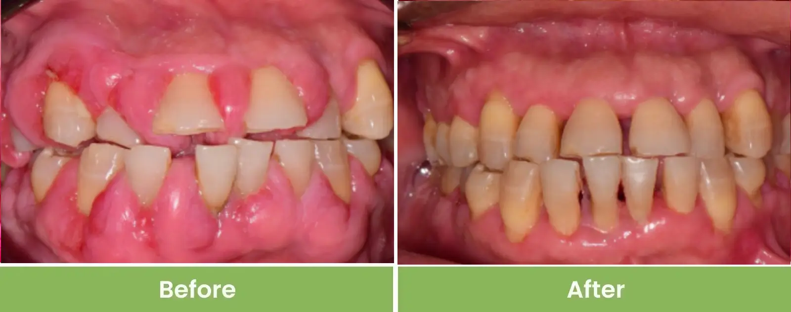 gum1
