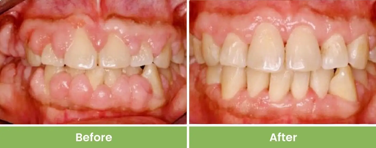 gum3