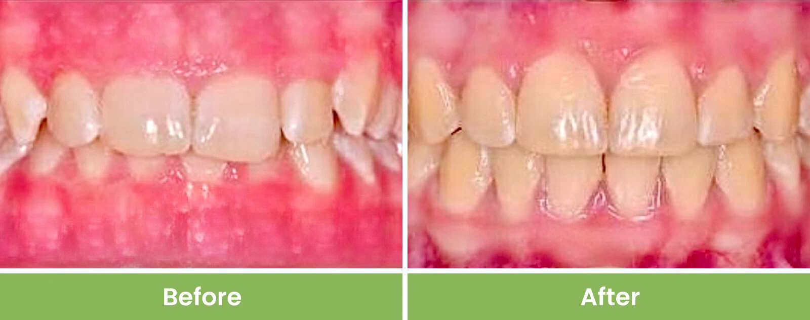 gum4